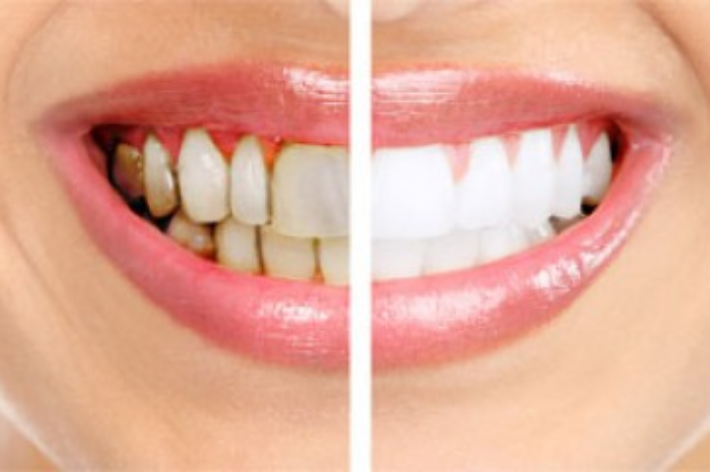 blog - Hello Dental