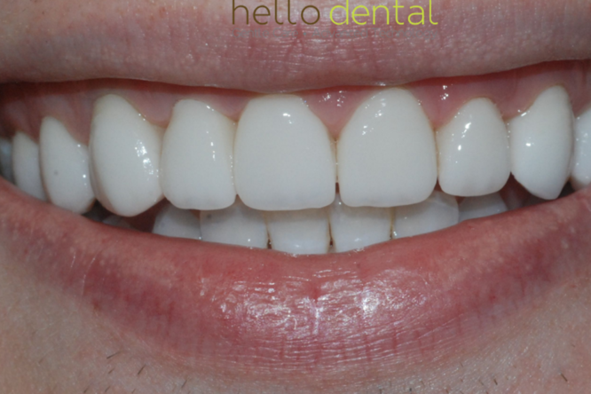 After - Hello Dental