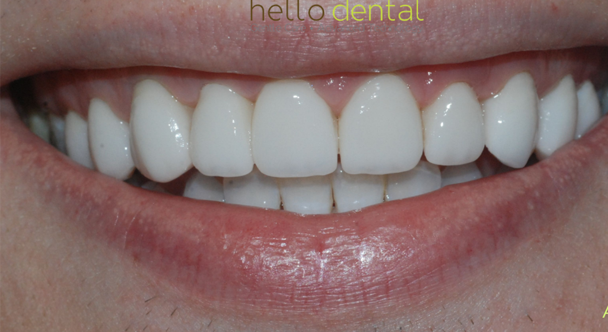 After - Hello Dental