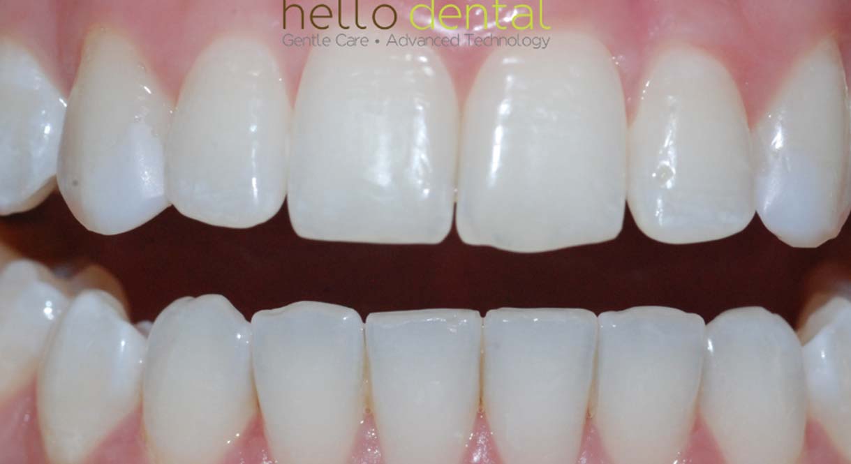 After - Hello Dental