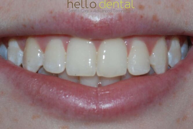 After - Hello Dental