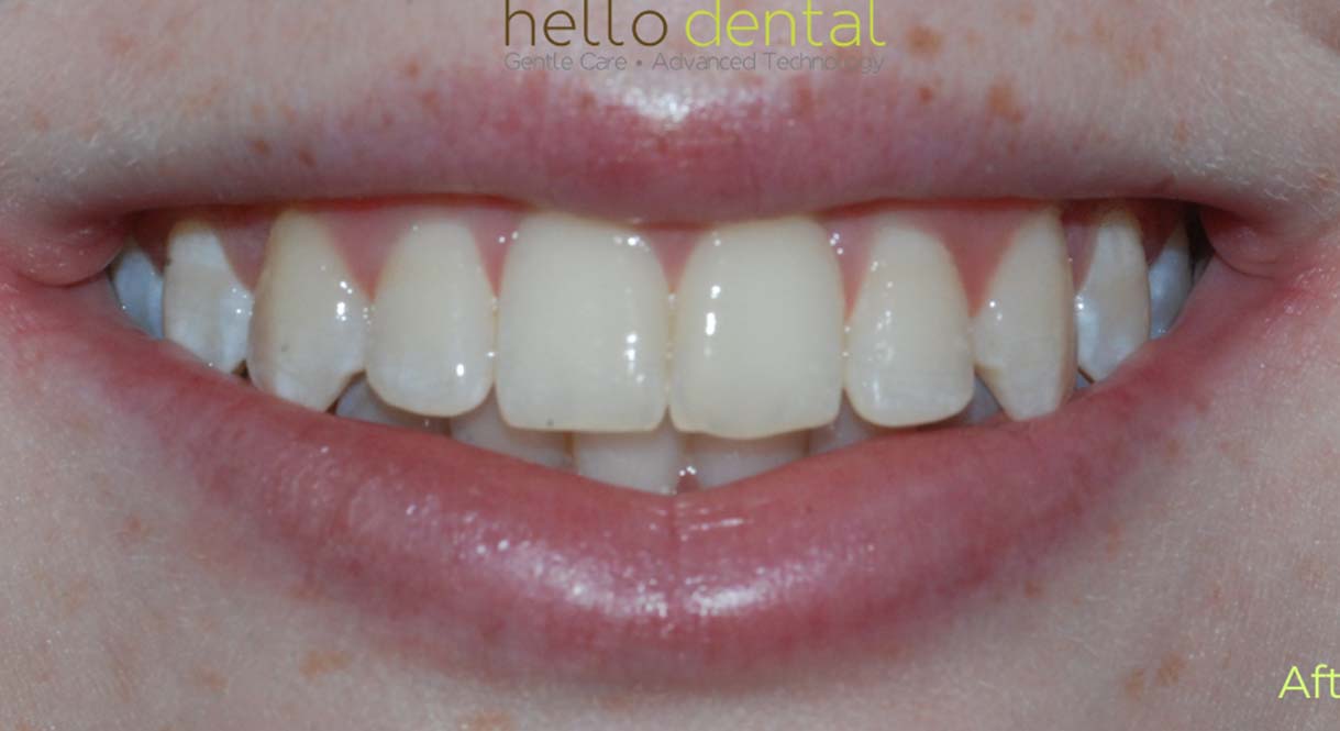 After - Hello Dental