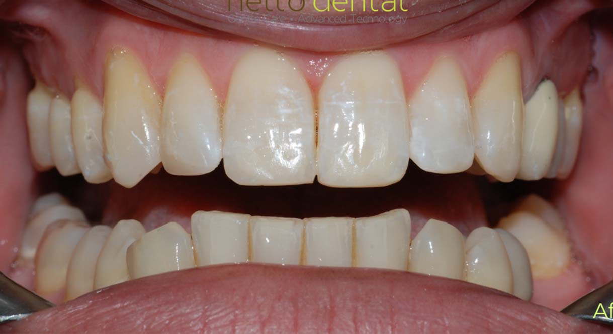 After - Hello Dental