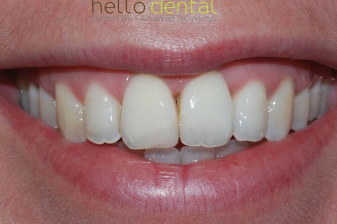 After - Hello Dental